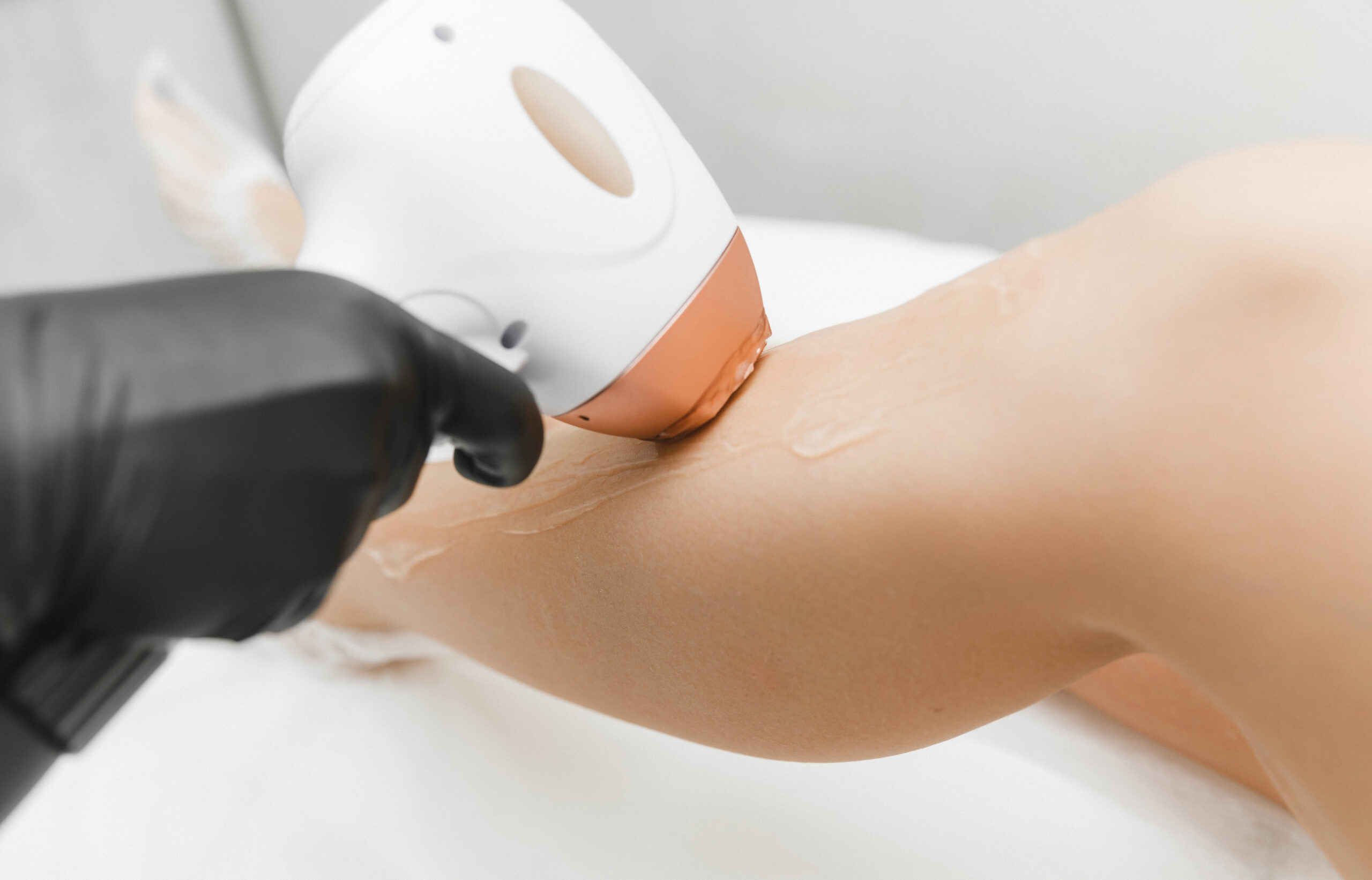 a young woman lies with her eyes closed and raises her hand up during the laser hair removal procedure. laser hair removal of the whole body.